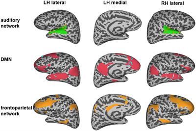 Electrical stimulation mapping in the medial prefrontal cortex induced auditory hallucinations of episodic memory: A case report